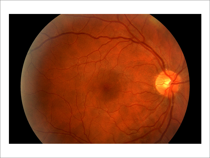 Diabetic Retinapathy