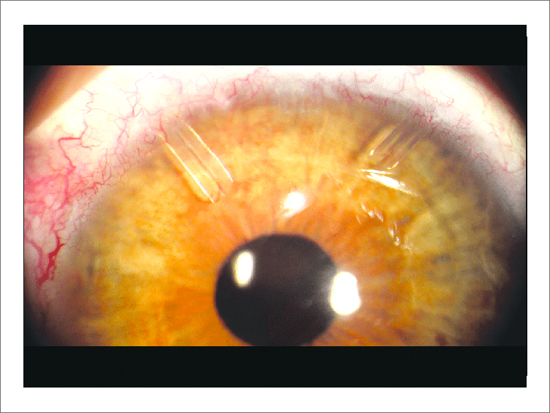 Glaucoma Valve Surgery