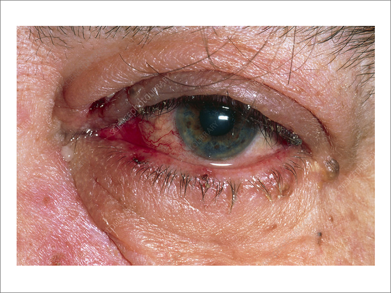 Herpes Zoster / Shingles