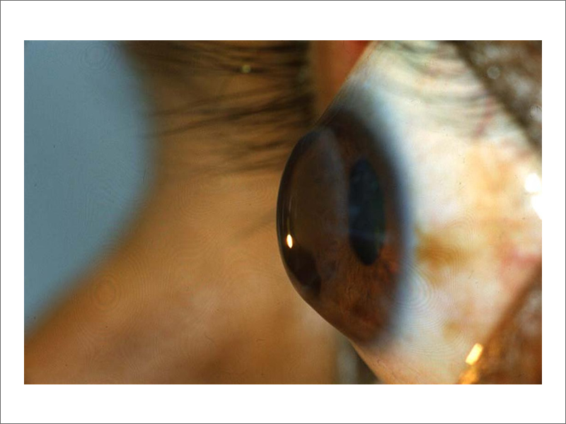 Keratoconus