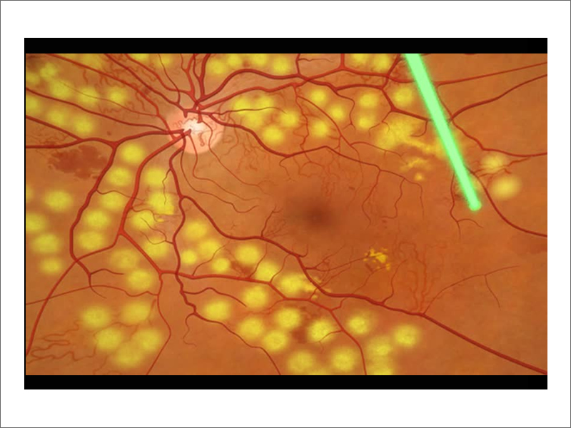 Laser Treatment - Yellow