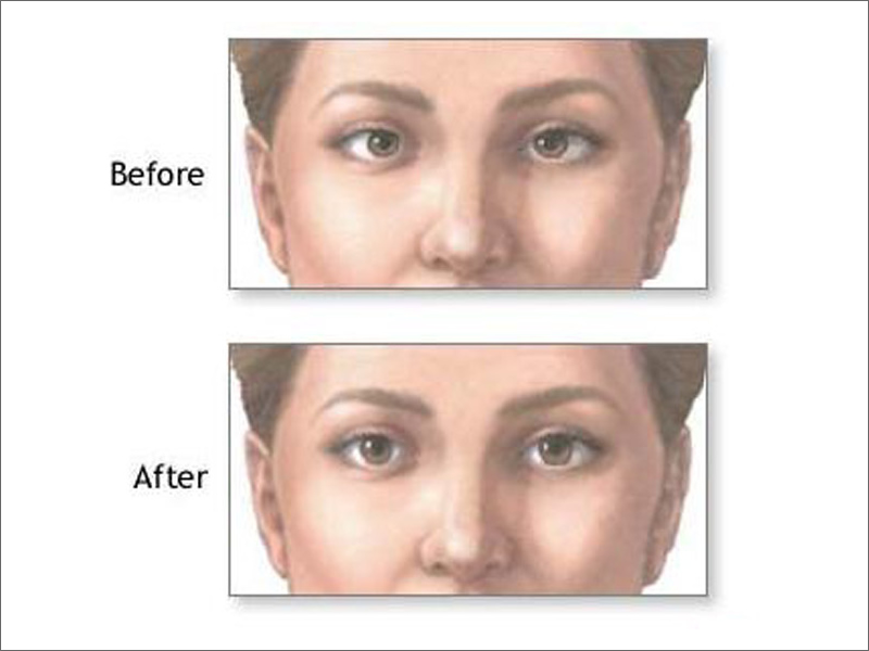 Amblyopia