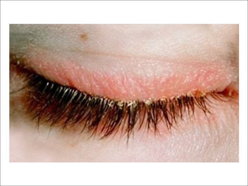 Blepharitis