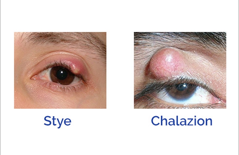 Chalazion / Stye