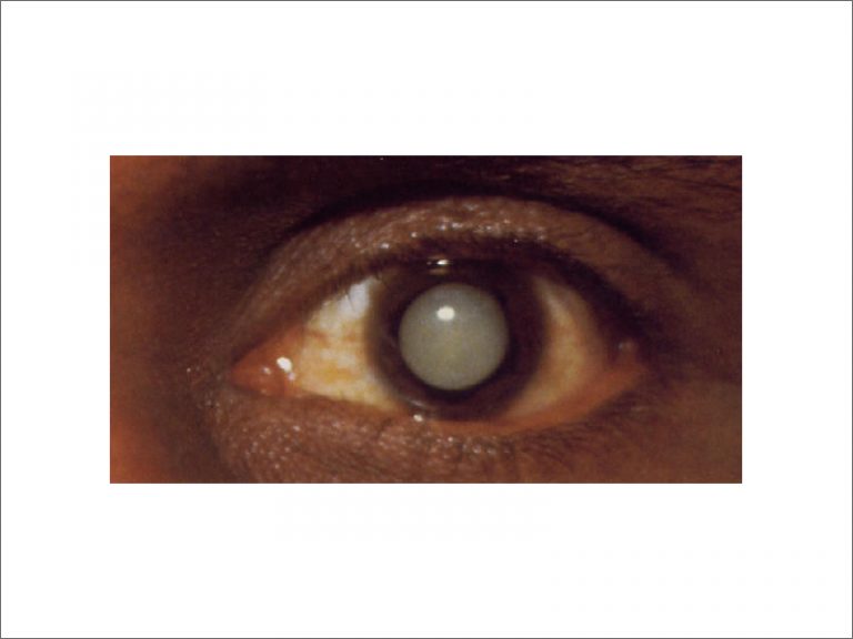 Complicated Cataract