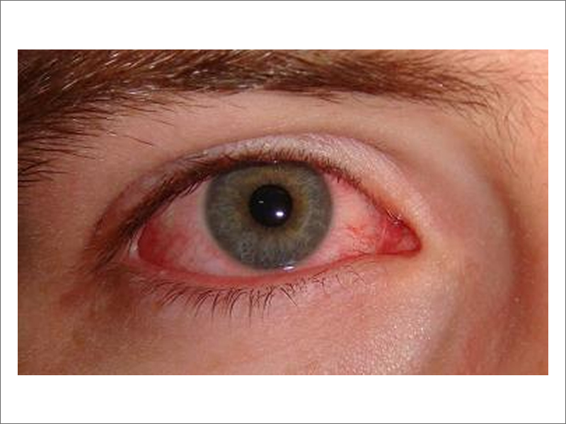 Conjunctivitis