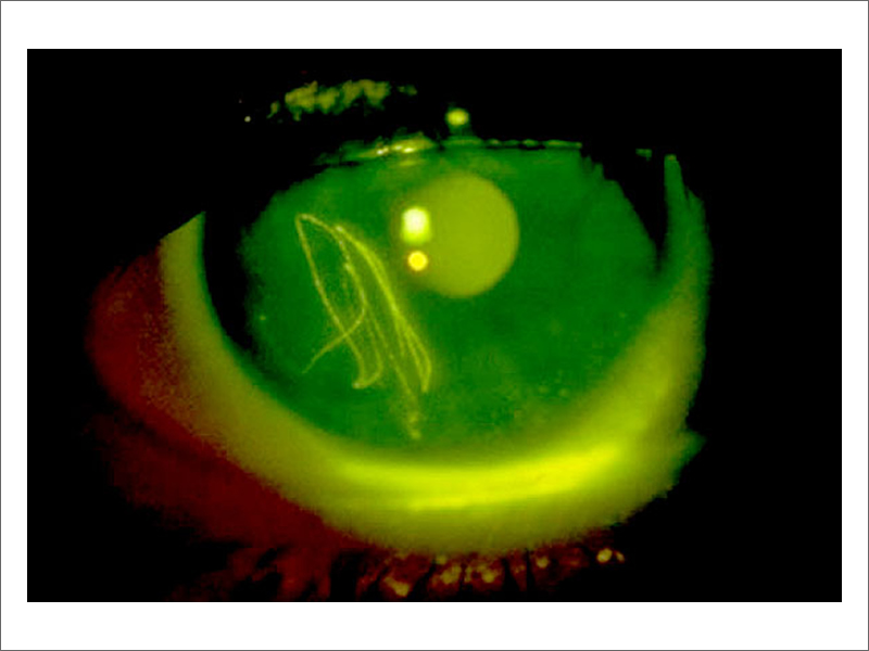 Corneal Abrasion