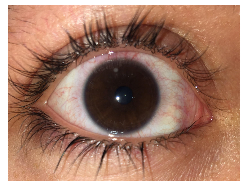 corneal ulcers treatment