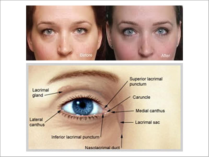 DCT Surgery