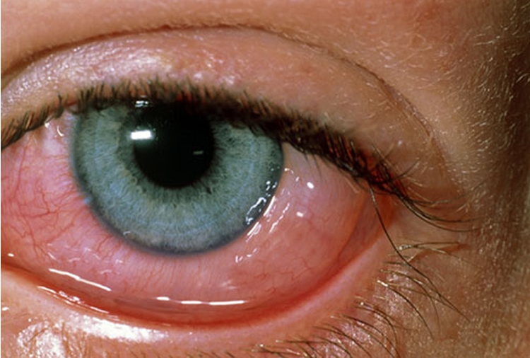 Eye Allergies