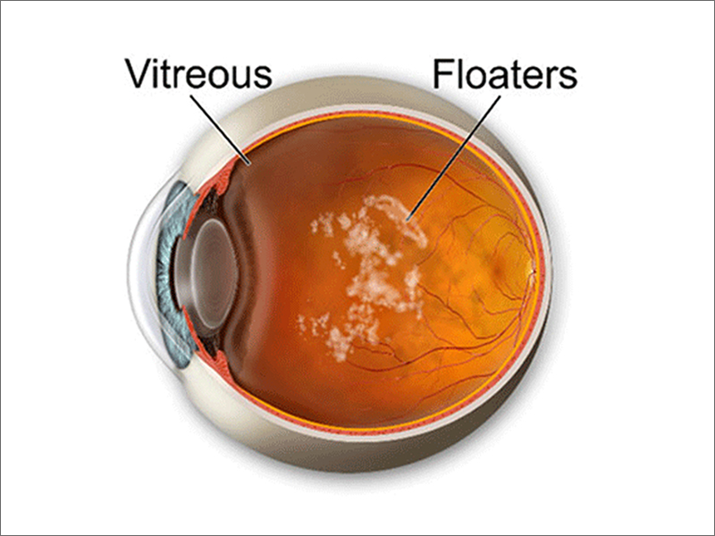 Floaters And Flashes