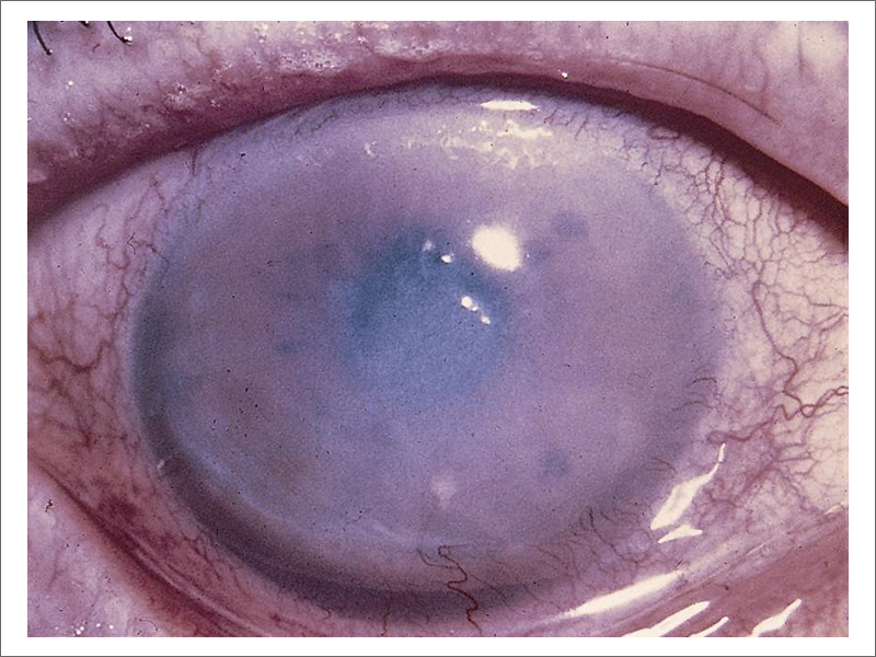 Fuchs' Dystrophy