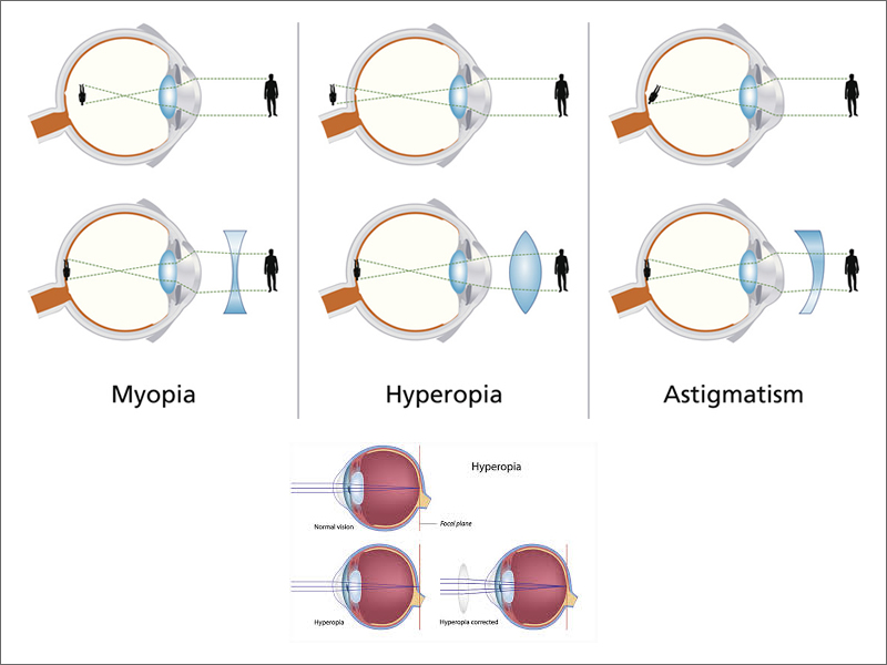Hyperopia / Farsightedness