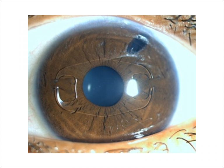 Iris Claw Lenses