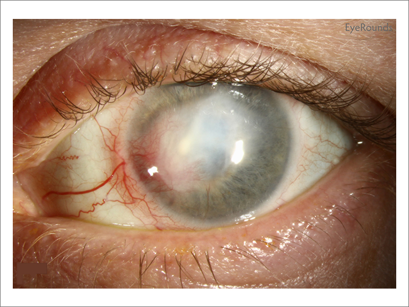 Keratitis