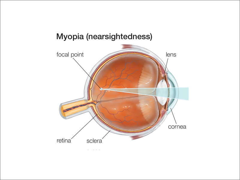 Myopia / Nearsightedness
