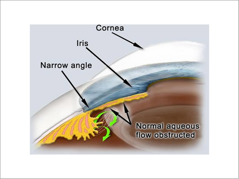 Narrow Angle Glaucoma