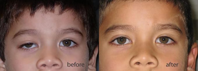 oculoplasty_surgery