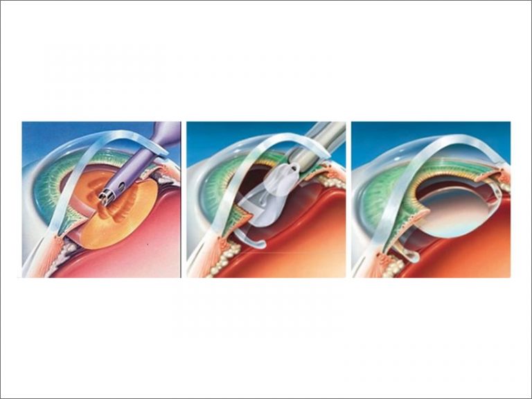 Phacoemulsification