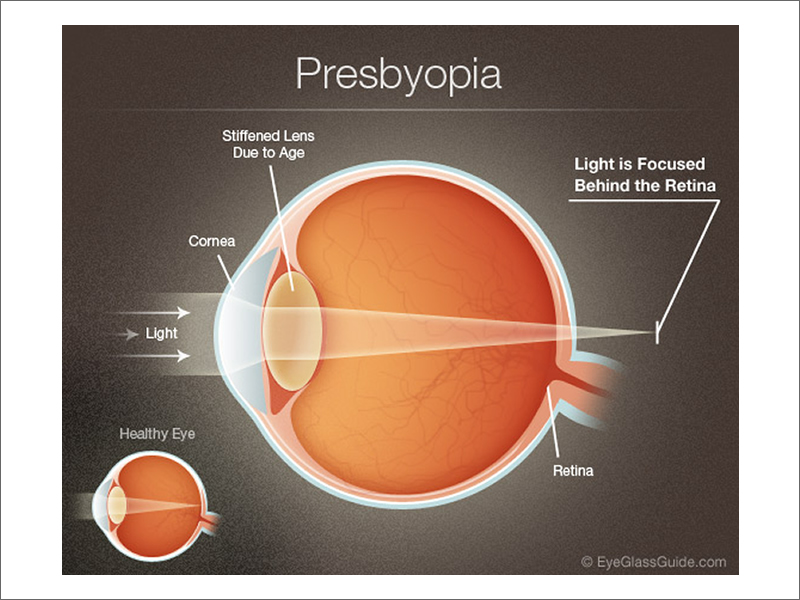 Presbyopia