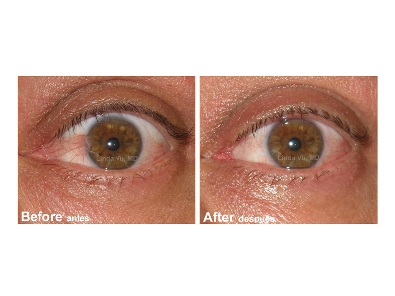Pterygium
