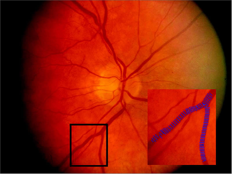 Retinal Vascular Disease