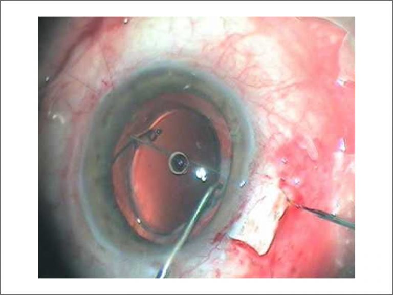 Scleral Fixation IOL