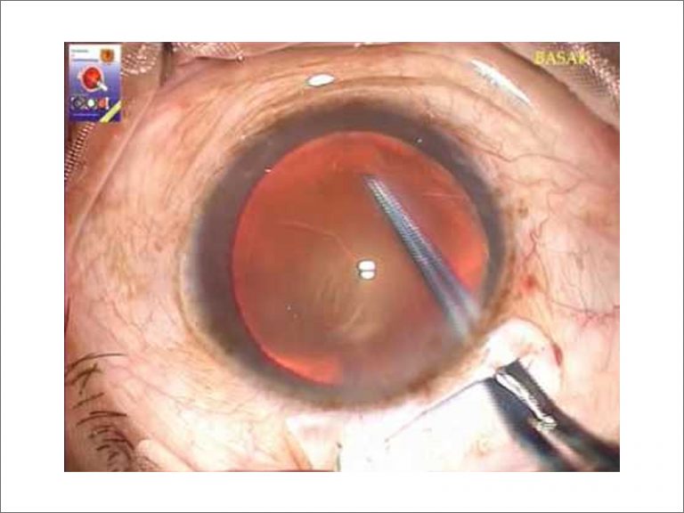 Small Incision Cataract Surgery