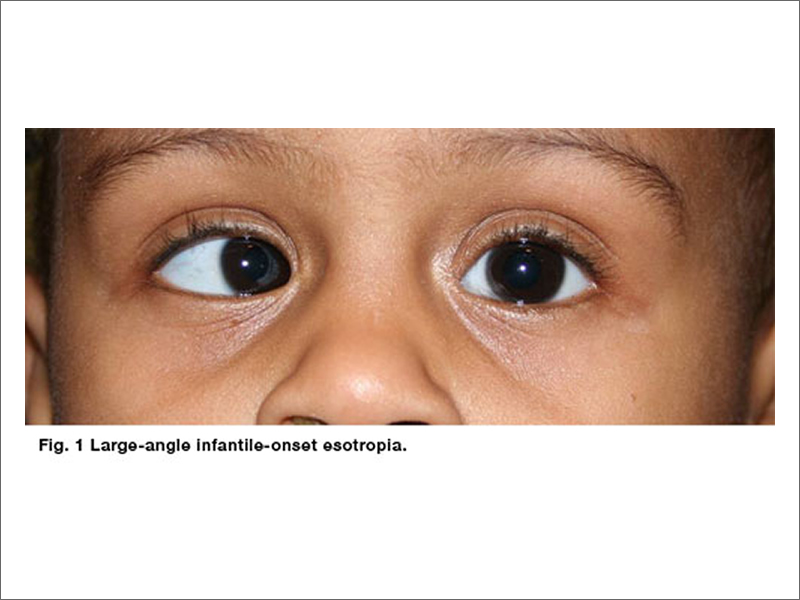 Strabismus