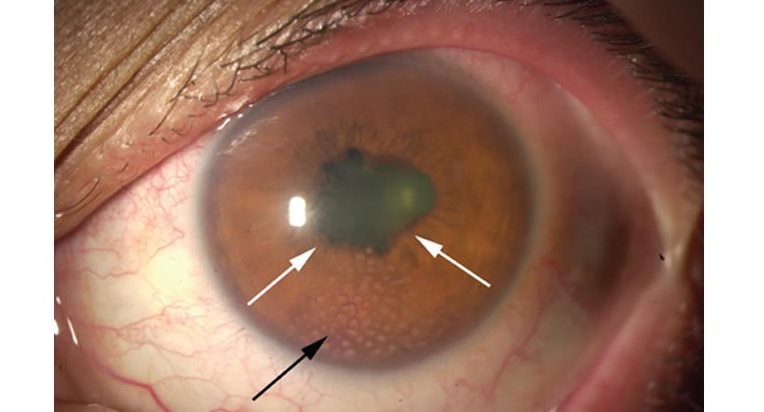 uveitis_iritis