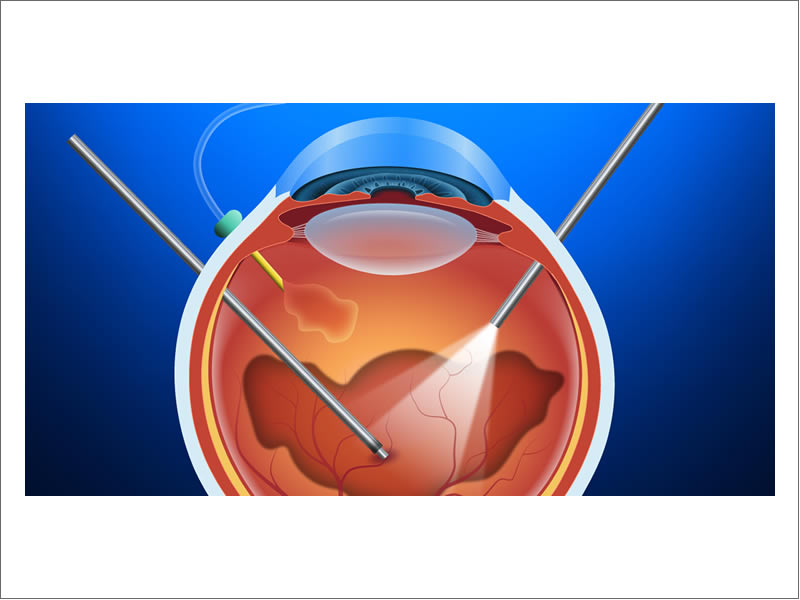 Vitrectomy