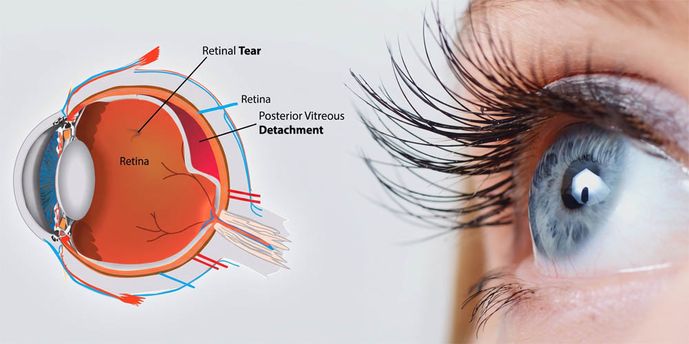 Best-Vitreo-Retinal-Treatment-in-Pune