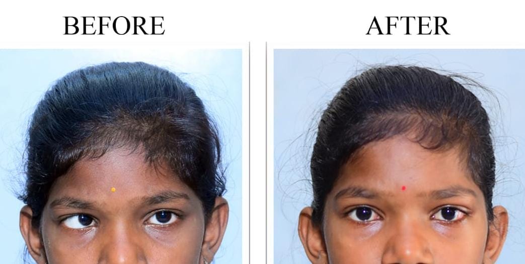 Best-Squint-Surgery-Doctors-in-Pune